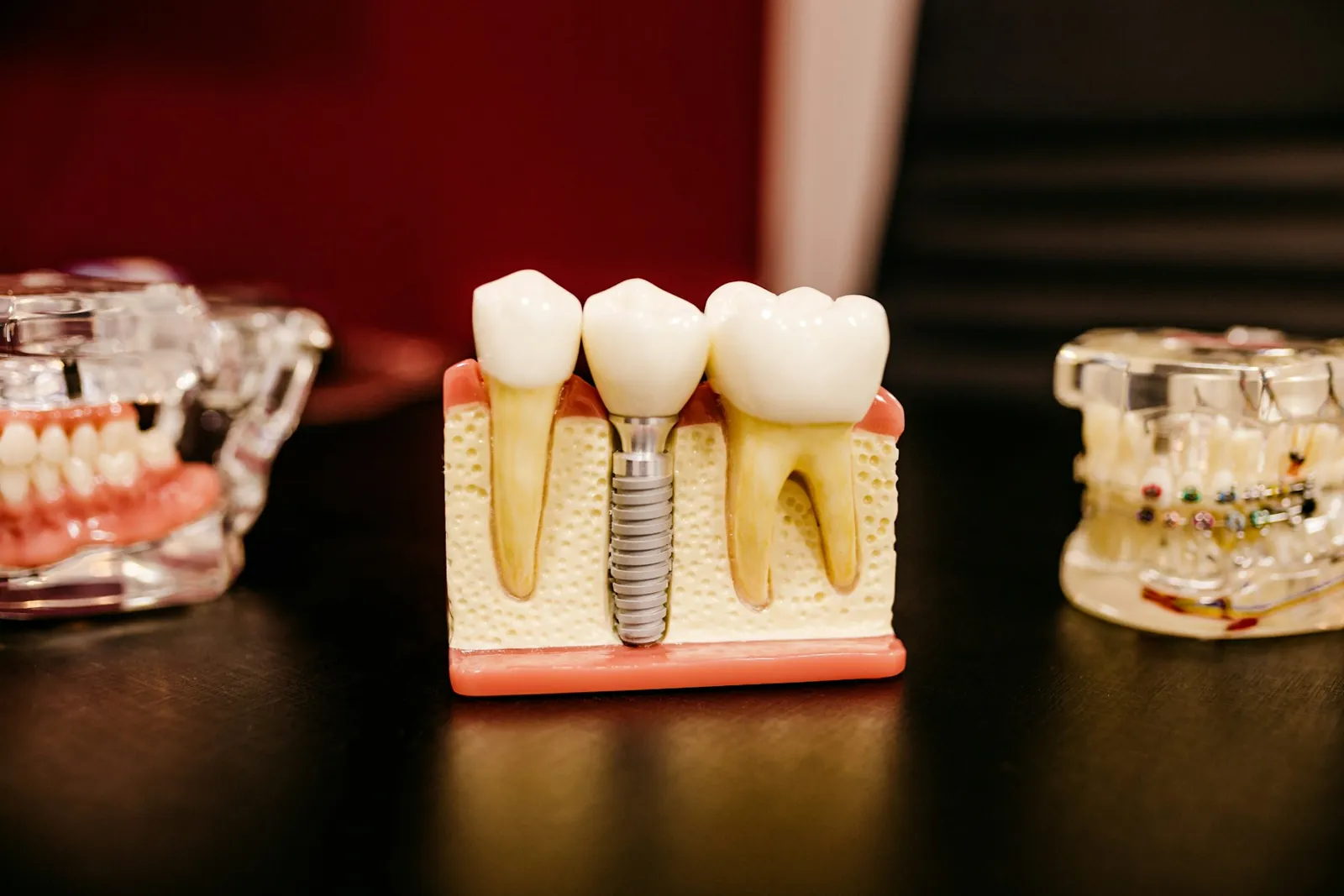 Çene modeli üzerinde implant ve üst yapısı